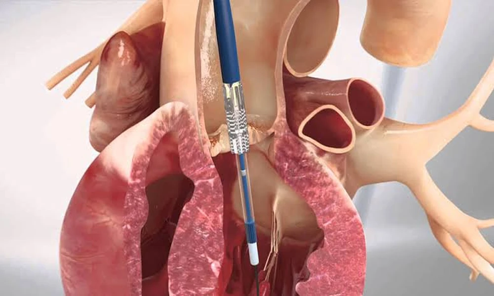 Heart Valve Replacement in India for Patients from Nigeria, Kenya and Somalia: How to Plan It Properly